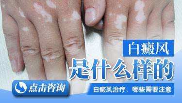 女性早期的白癜风症状是什么样的